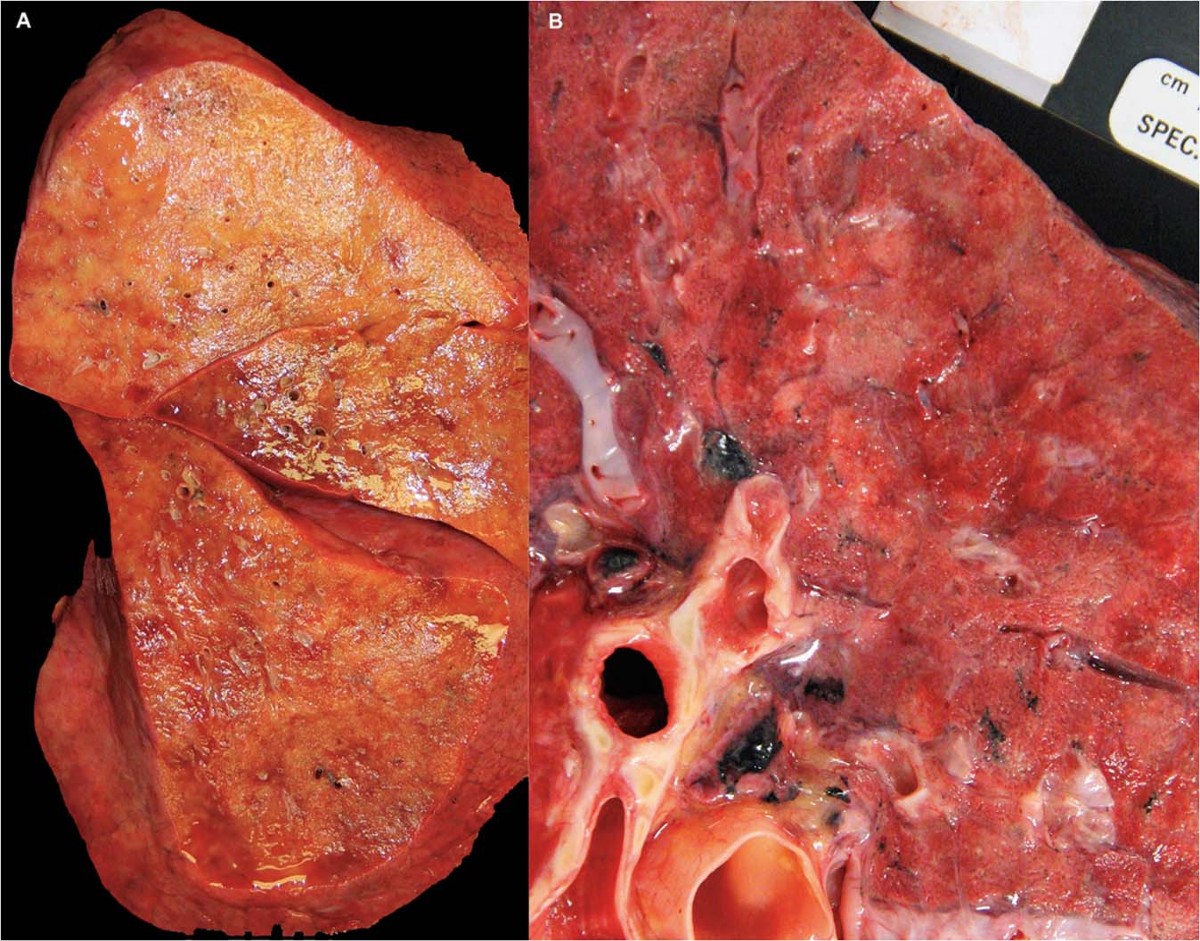 autupsy COVID-19 pulmonary pathology: a multi-institutional autopsy cohort from  Italy and New York City | Modern Pathology