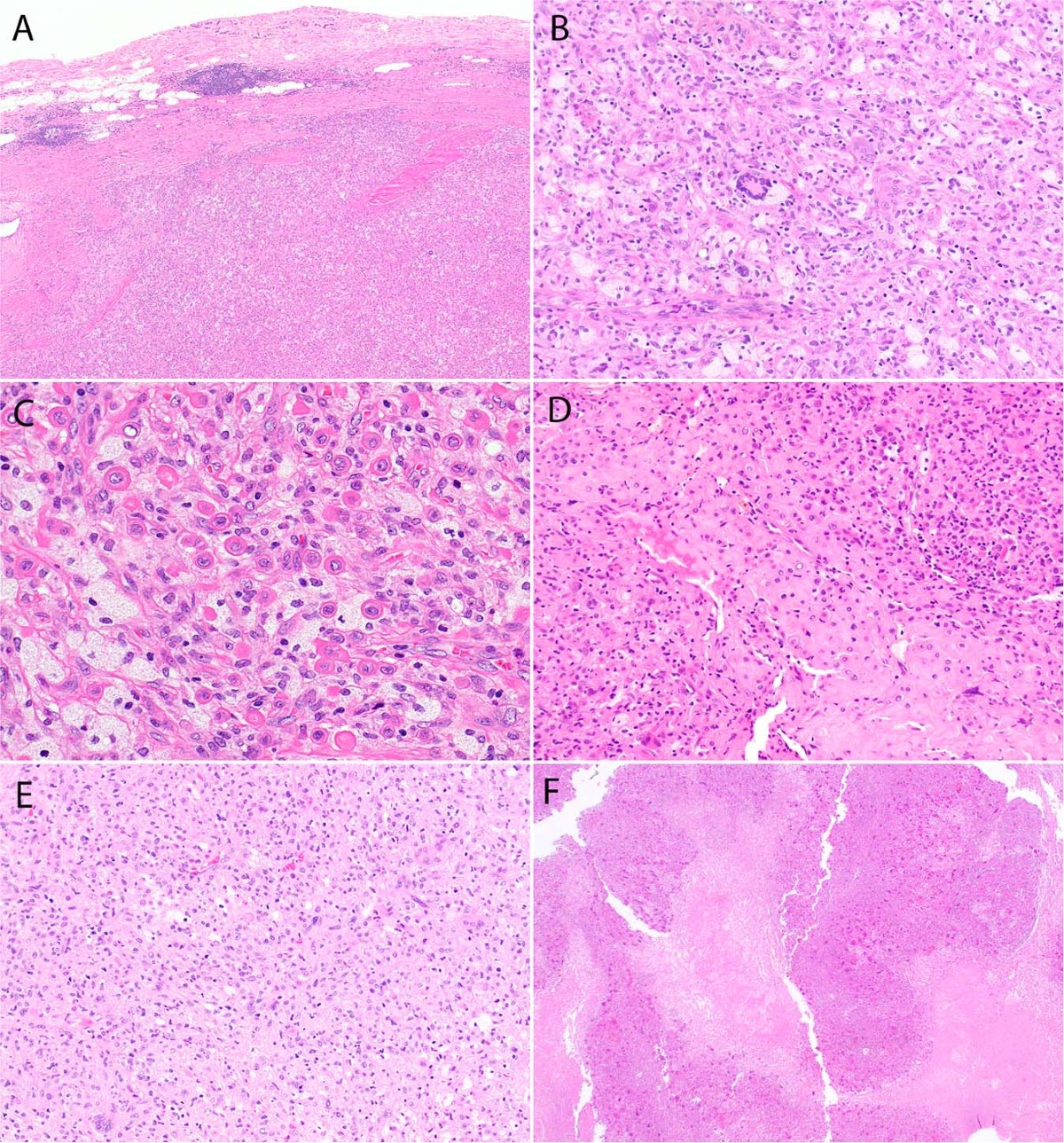 Flat type verruciform xanthoma of the tongue and its differential diagnosis, image size:1200x1289
