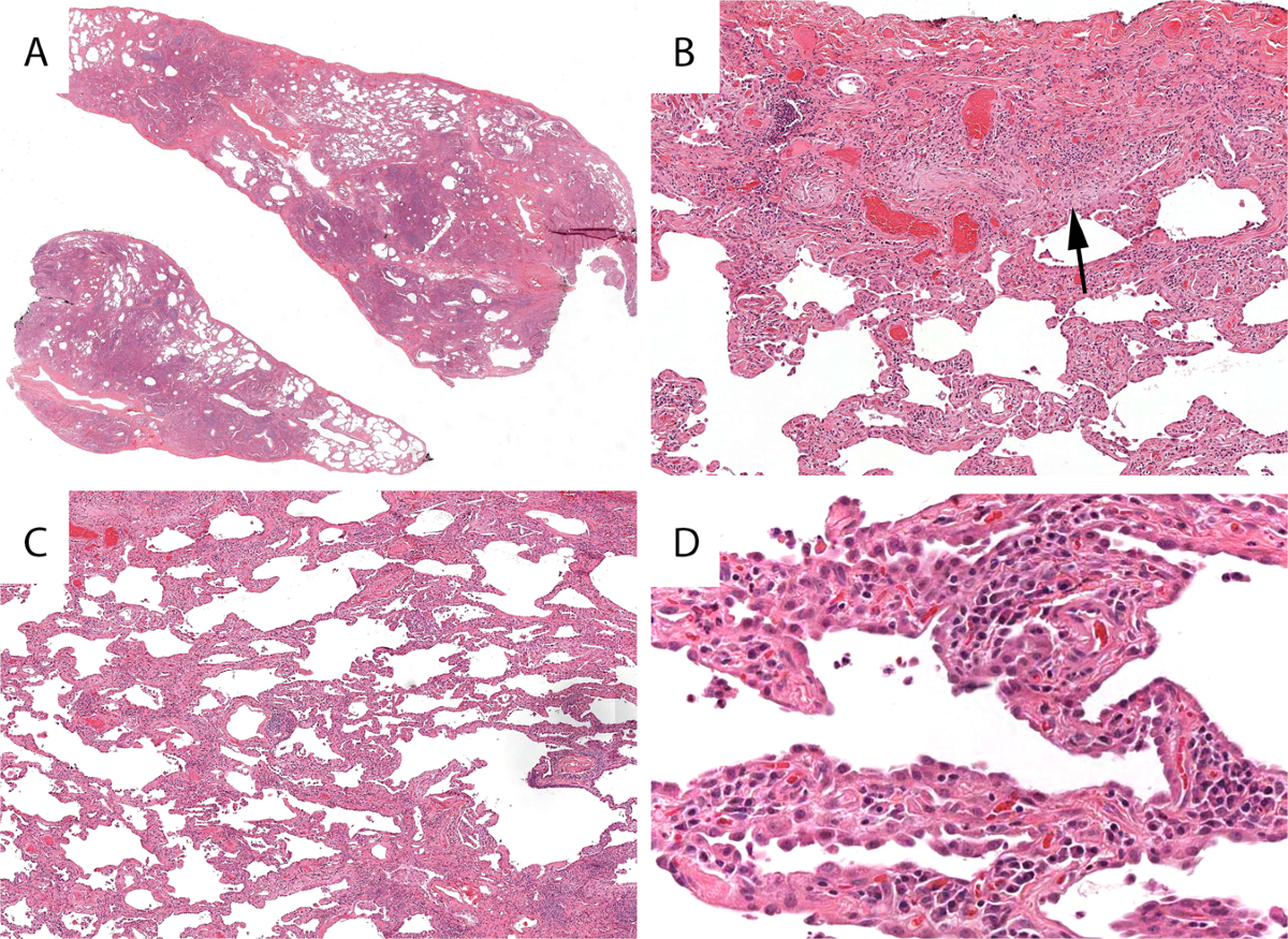 The histologic diagnosis of usual interstitial pneumonia of 