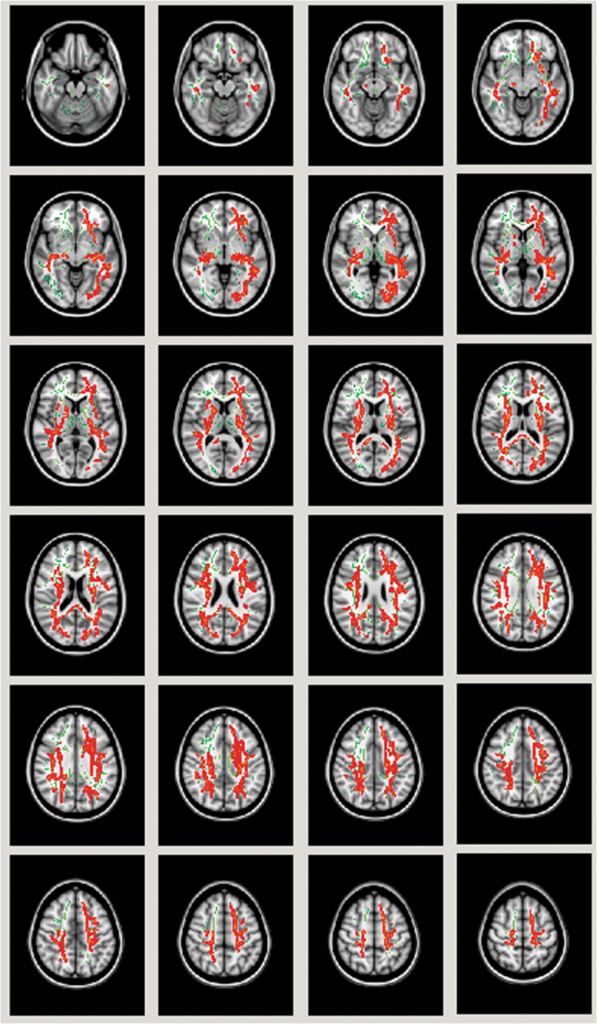 Extracellular free water and glutathione in first-episode psychosis—a  multimodal investigation of an inflammatory model for psychosis