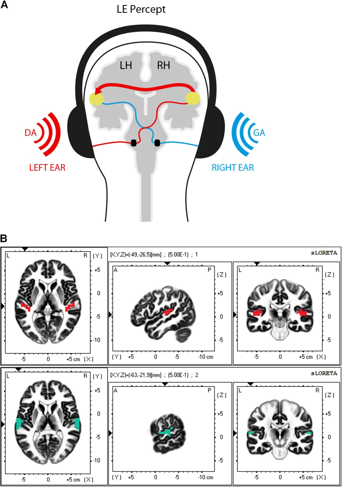 alterations-in-interhemispheric-gamma-band-connectivity-are-related-to-the-emergence-of-auditory-verbal-hallucinations-in-healthy-subjects-during-nmda-receptor-blockade-neuropsychopharmacology