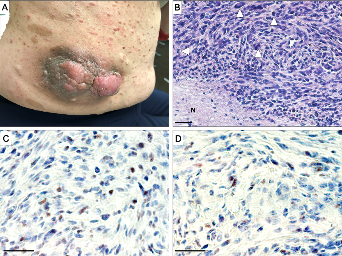 melanotic peripheral nerve sheath sarcoma Malignant peripheral nerve sheath tumor: models, biology, and translation