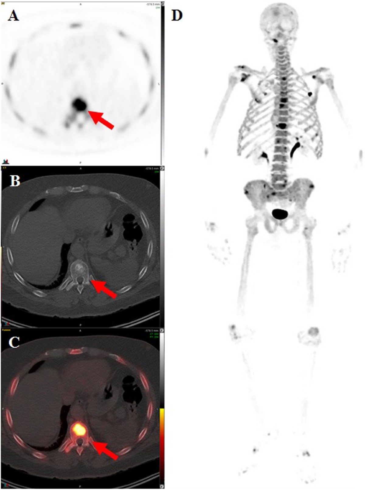 The use of PET/CT in prostate cancer | Prostate Cancer and Prostatic  Diseases, image size:1200x1611