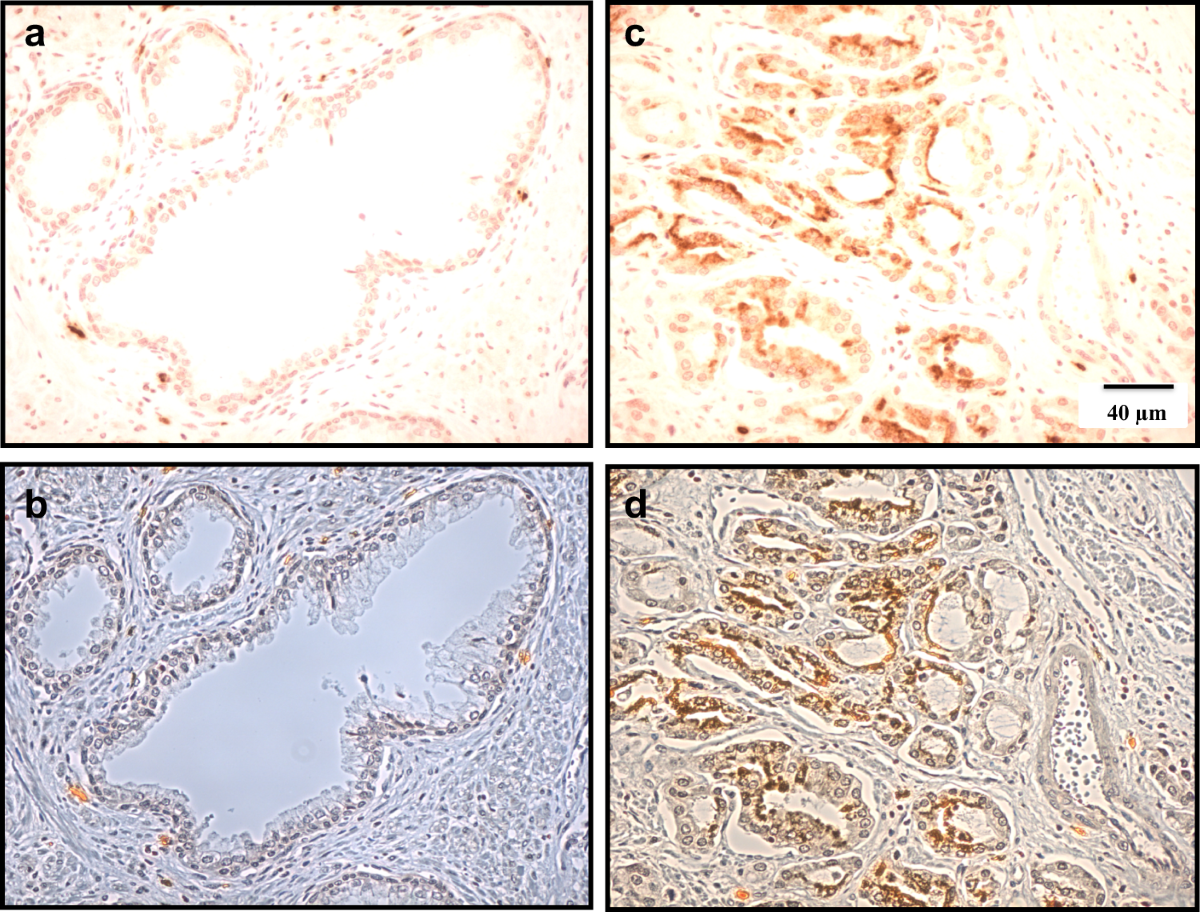 Anti-metastatic effect of ranolazine in an in vivo rat model of prostate  cancer, and expression of voltage-gated sodium channel protein in human  prostate | Prostate Cancer and Prostatic Diseases
