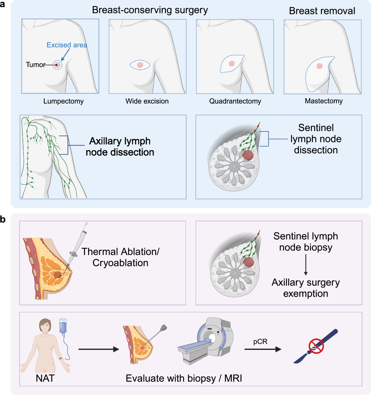 Breast cancer: pathogenesis and treatments | Signal Transduction and Targeted Therapy
