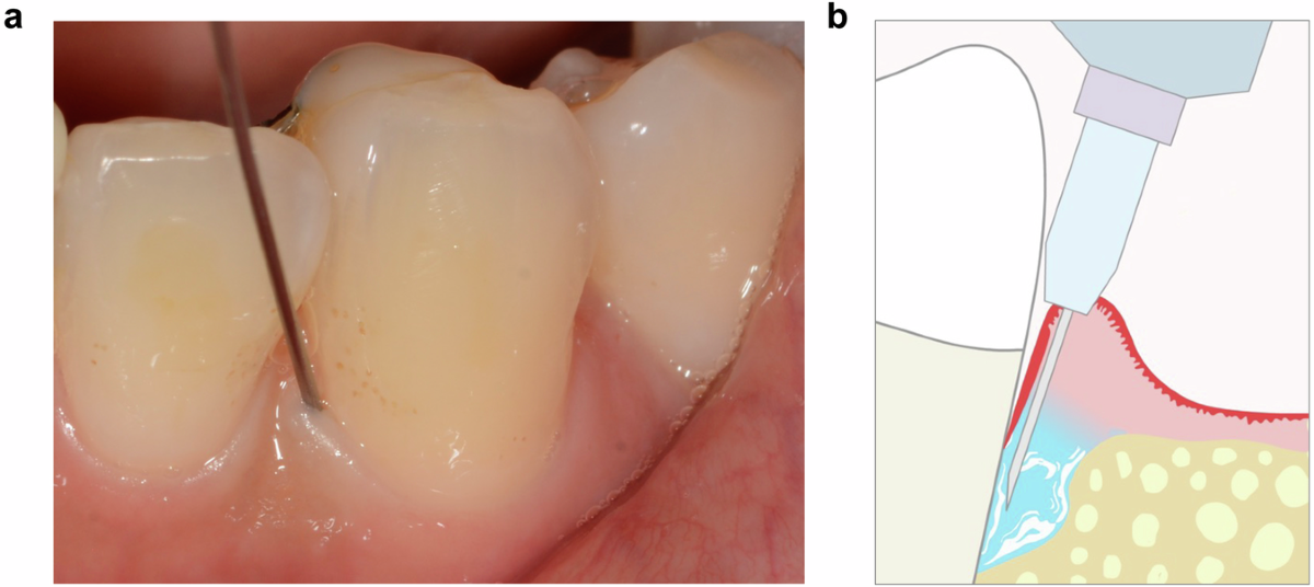 bpc-157 periodontal regeneration clinical trial Impact of allogeneic dental pulp stem cell injection on tissue regeneration  in periodontitis: a multicenter randomized clinical trial