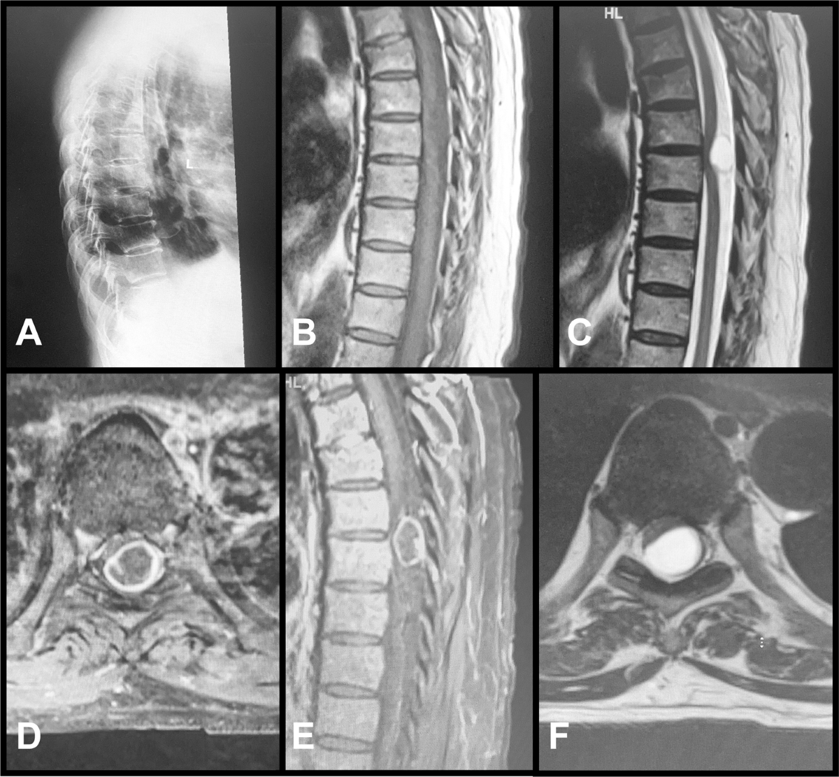 Thoracic cystic schwannoma: case report and review of literature | Spinal  Cord Series and Cases