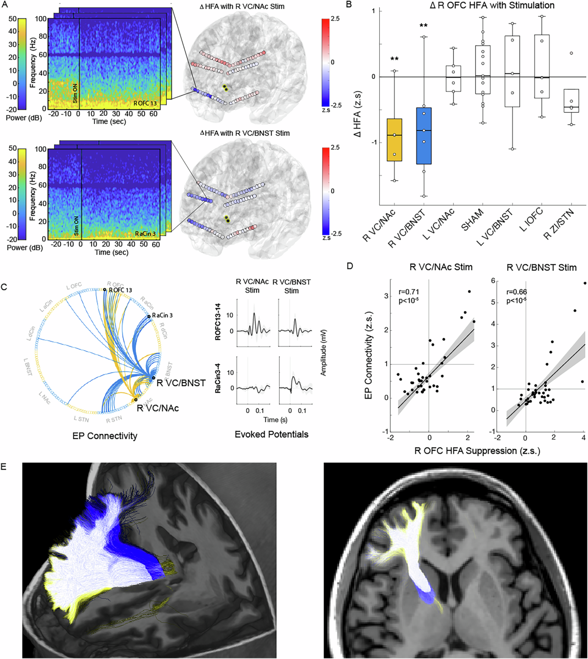 Invasive brain mapping identifies personalized therapeutic neuromodulation  targets that suppress OCD network activity | Translational Psychiatry