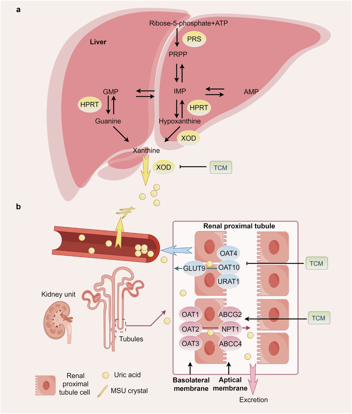 glutathione for gout arthritis Therapeutic potential and pharmacological mechanisms of Traditional Chinese  Medicine in gout treatment