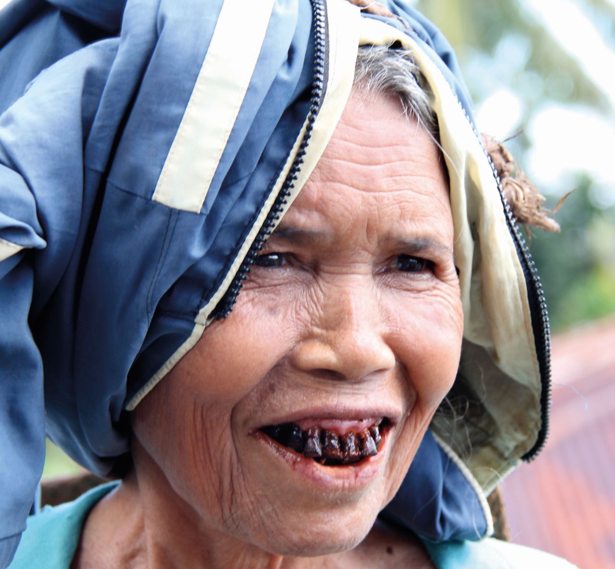 Black teeth | BDJ Student