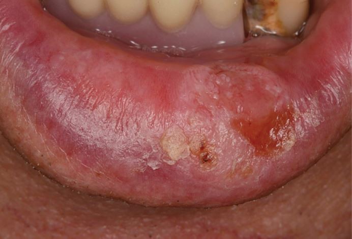 Spotting the signs and symptoms of lip cancer in patients
