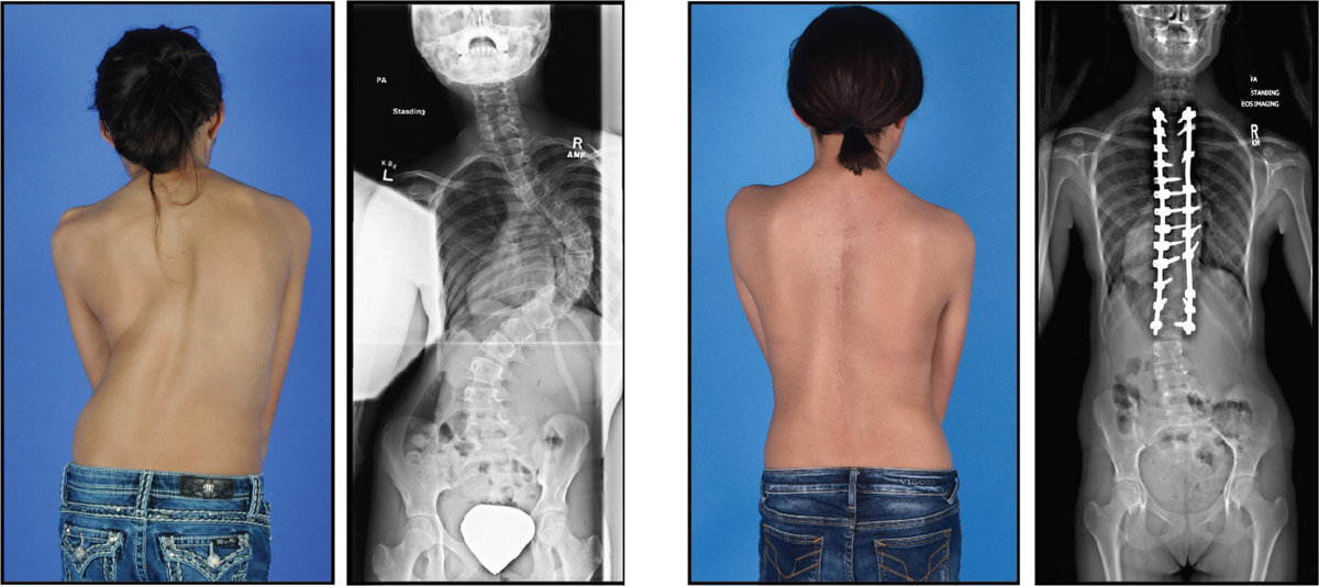 The cartilage matrisome in adolescent idiopathic scoliosis | Bone Research