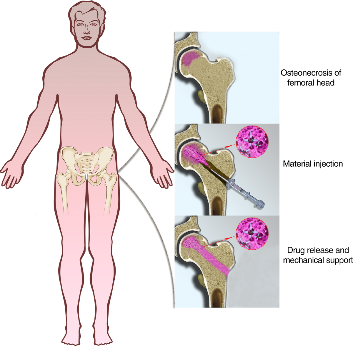 An injectable self-adaptive polymer as a drug carrier for the treatment of  nontraumatic early-stage osteonecrosis of the femoral head | Bone Research