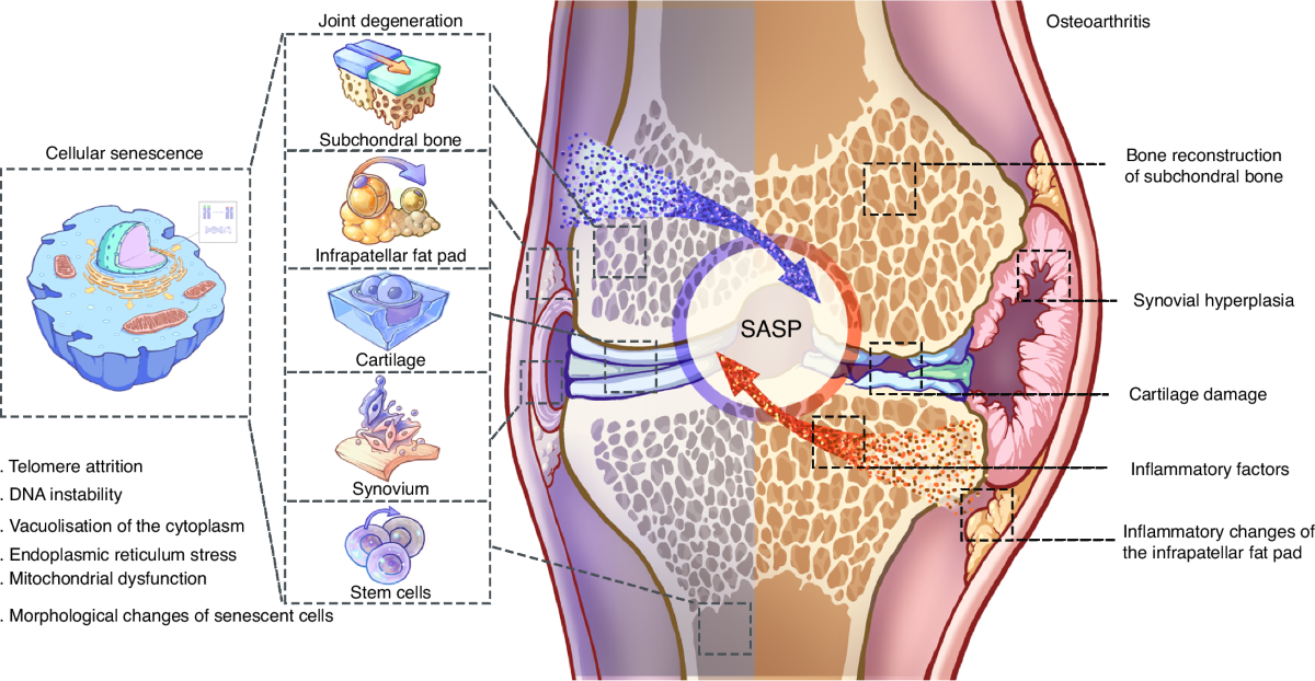 Cross-talk of inflammation and cellular senescence: a new insight into the  occurrence and progression of osteoarthritis | Bone Research