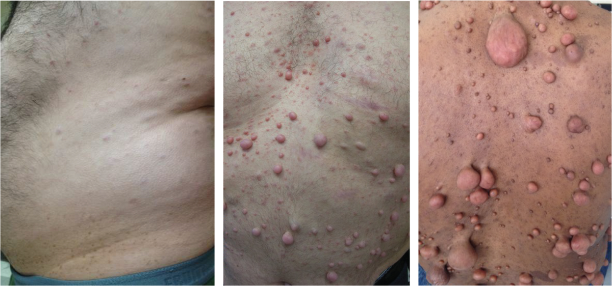 Cutaneous neurofibromas in the genomics era: current understanding and open  questions | British Journal of Cancer
