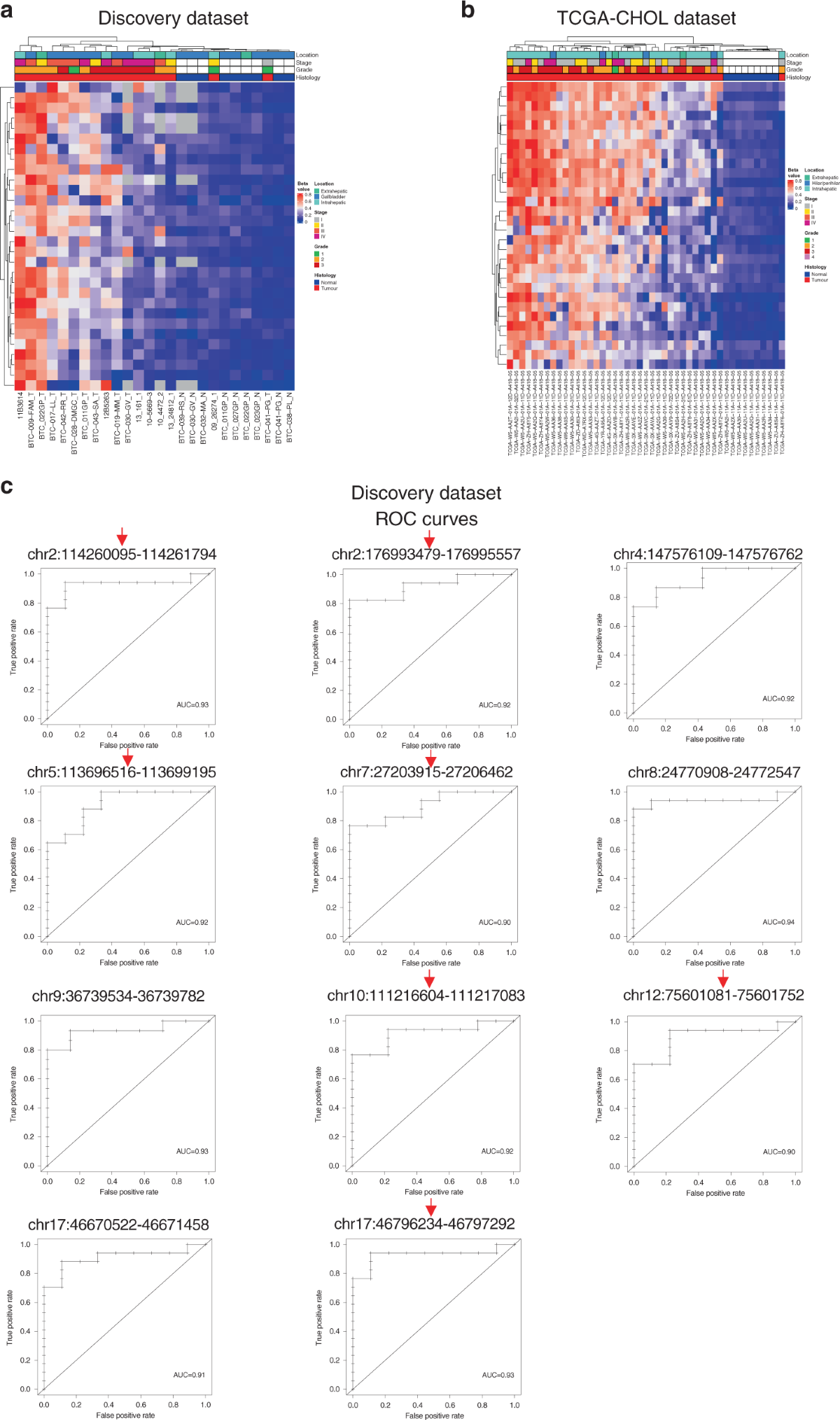 HOXD8 hypermethylation as a fully sensitive and specific biomarker for  biliary tract cancer detectable in tissue and bile samples | British  Journal of Cancer