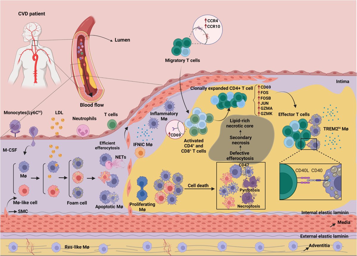 glutathione artheriolsclerosis Macrophage polarization and metabolism in atherosclerosis Cellular metabolism changes in atherosclerosis