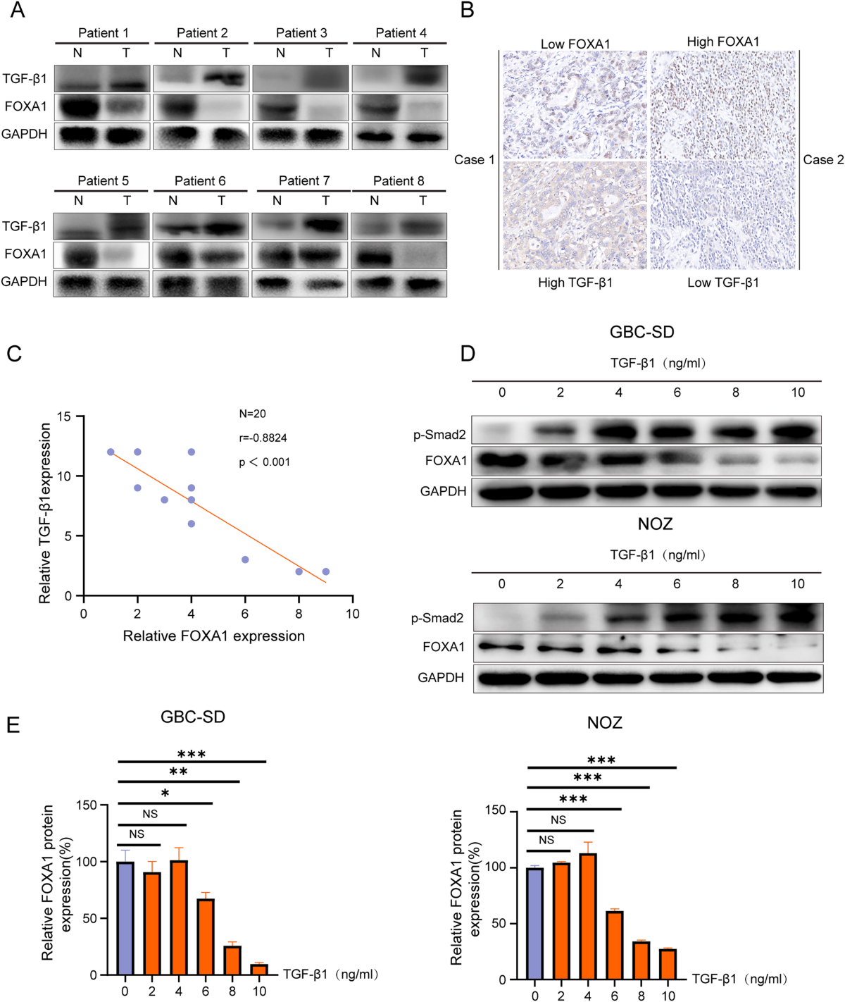TGF-1 facilitates gallbladder carcinoma metastasis by regulating FOXA1  translation efficiency through m6A modification | Cell Death & Disease