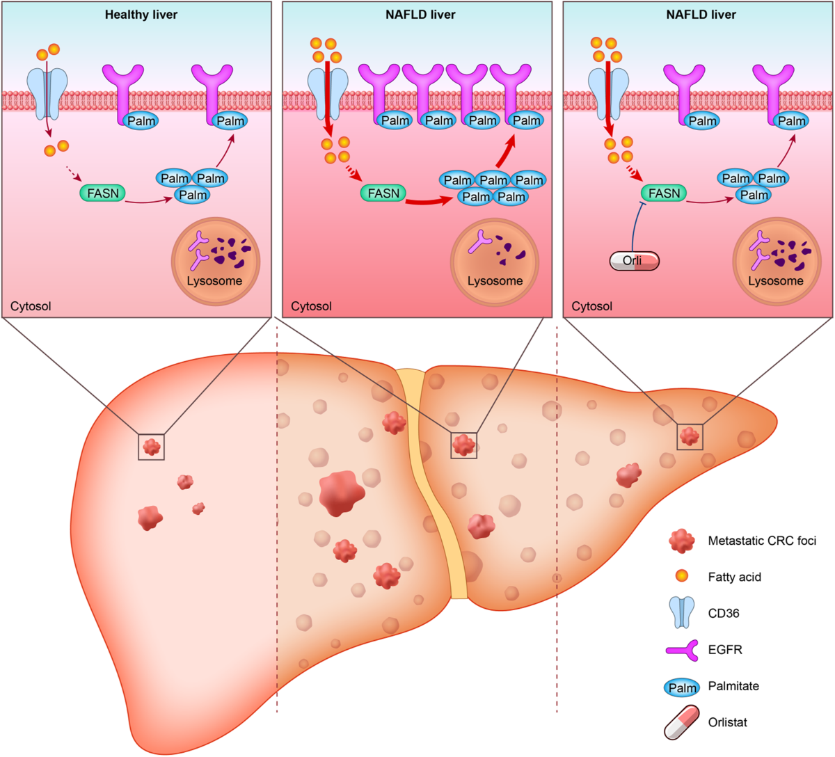 Non-alcoholic fatty liver disease promotes liver metastasis of colorectal  cancer via fatty acid synthase dependent EGFR palmitoylation | Cell Death  Discovery