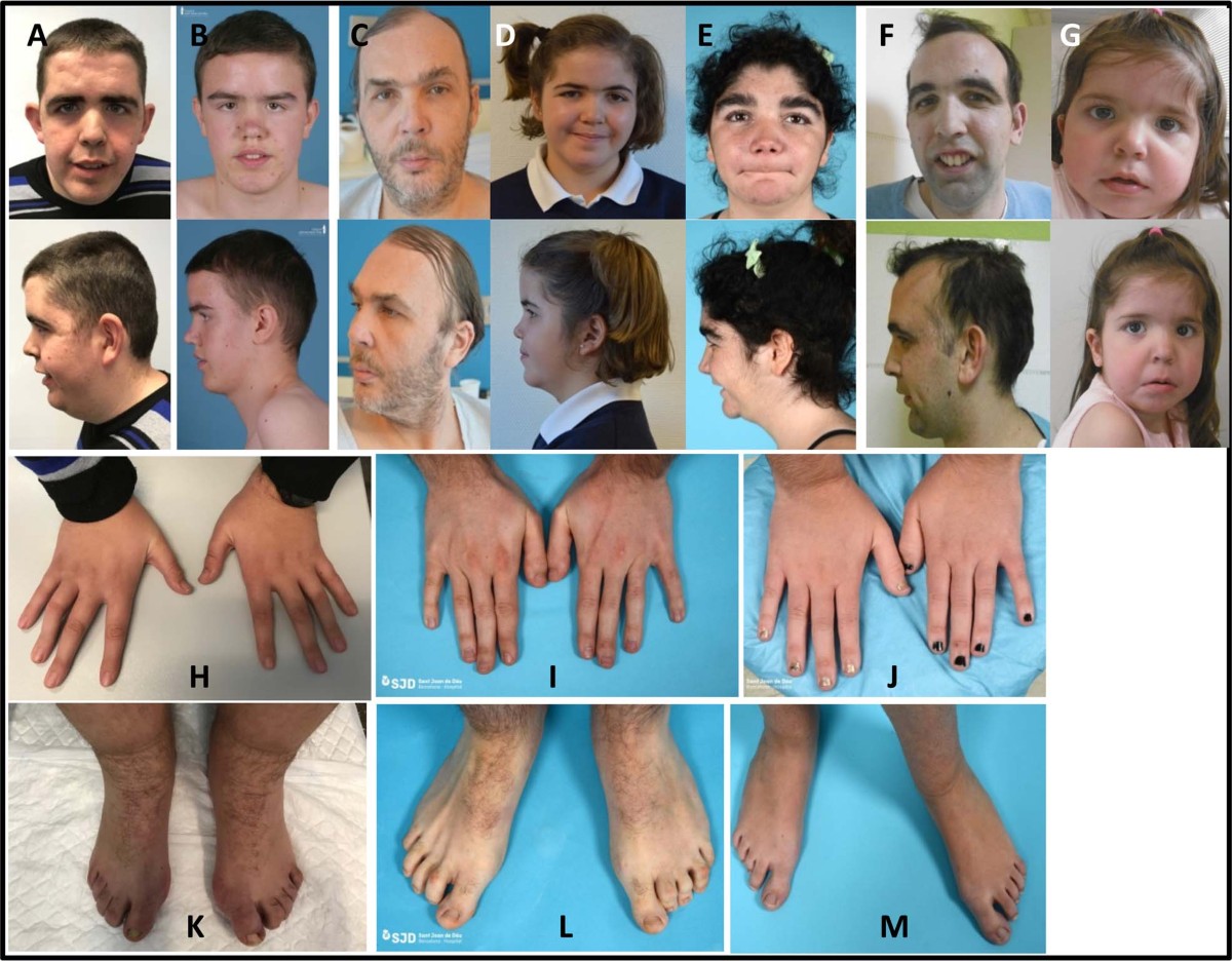 Further delineation of neuropsychiatric findings in Tatton-Brown-Rahman  syndrome due to disease-causing variants in DNMT3A: seven new patients |  European Journal of Human Genetics