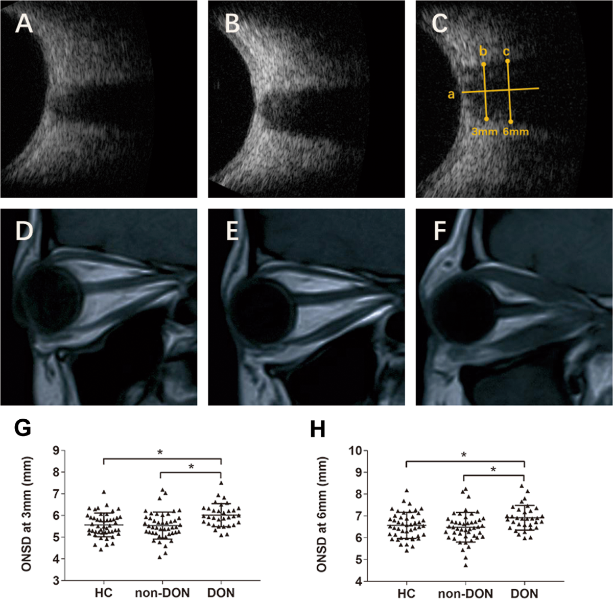 onsd-792  Ultrasonographic measurement of the optic nerve sheath diameter in  dysthyroid optic neuropathy | Eye