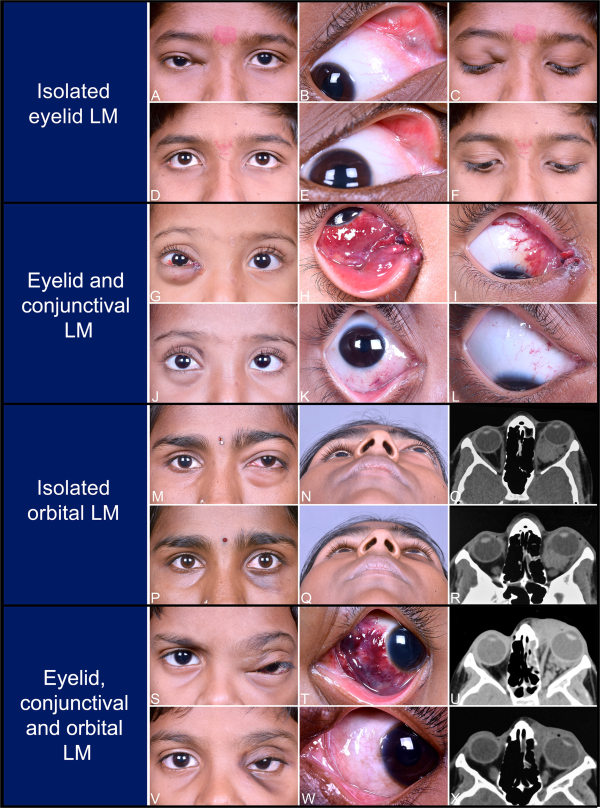Orbital lymphangioma | PPTX, image size:1200x1616
