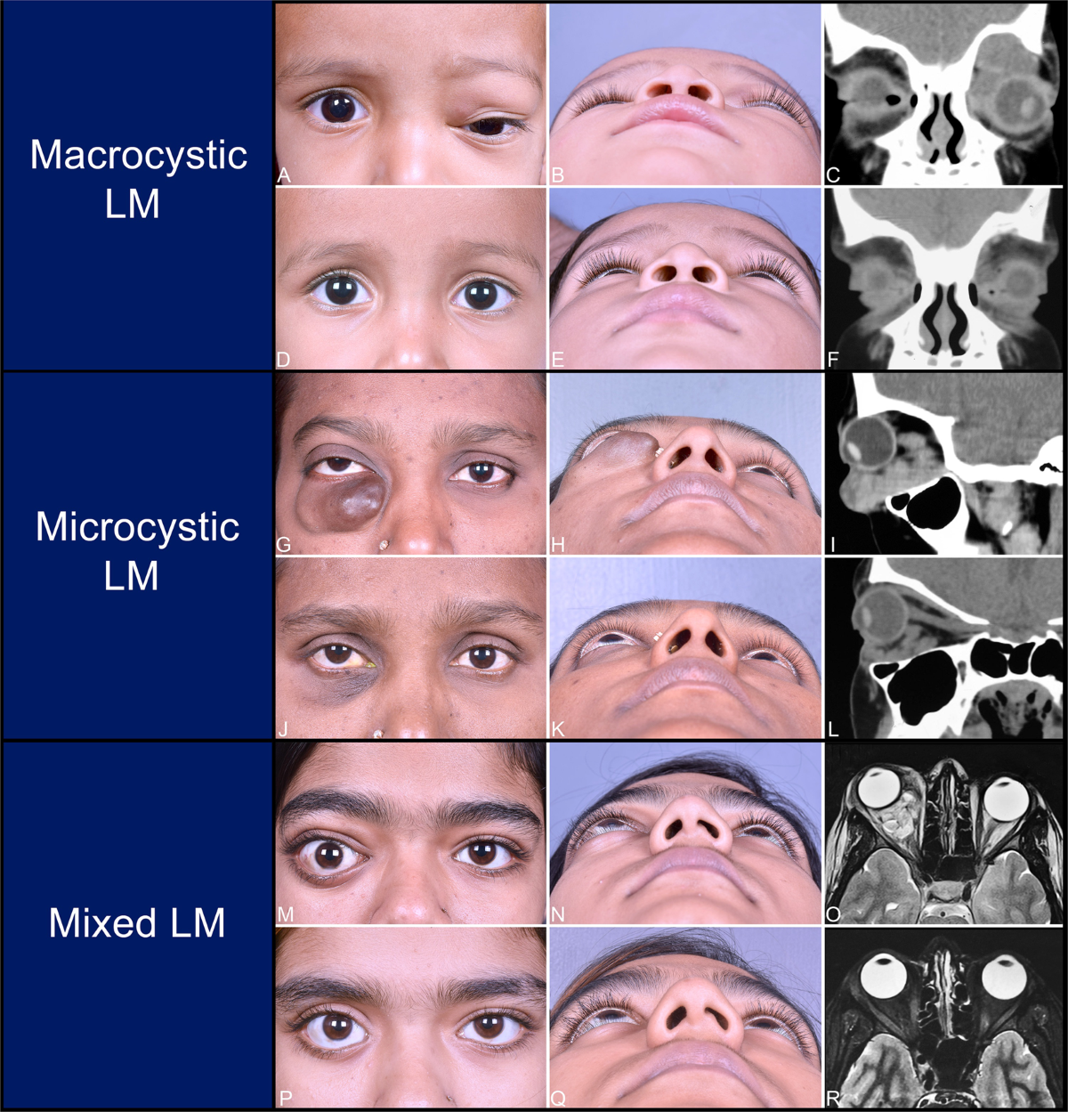 Orbital teratoma masquerading as lymphangioma - Journal of the American  Association for Pediatric Ophthalmology and Strabismus (JAAPOS), image size:1200x1249