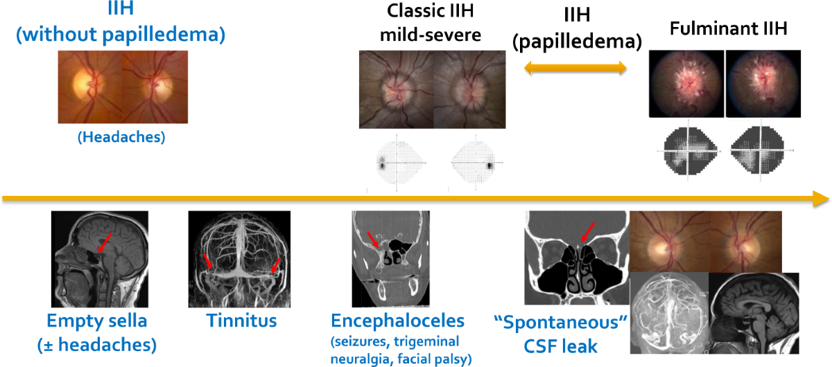 semaglutide intracranial hypertension Idiopathic and the Challenge of Weight Loss Idiopathic Intracranial Hypertension : New
