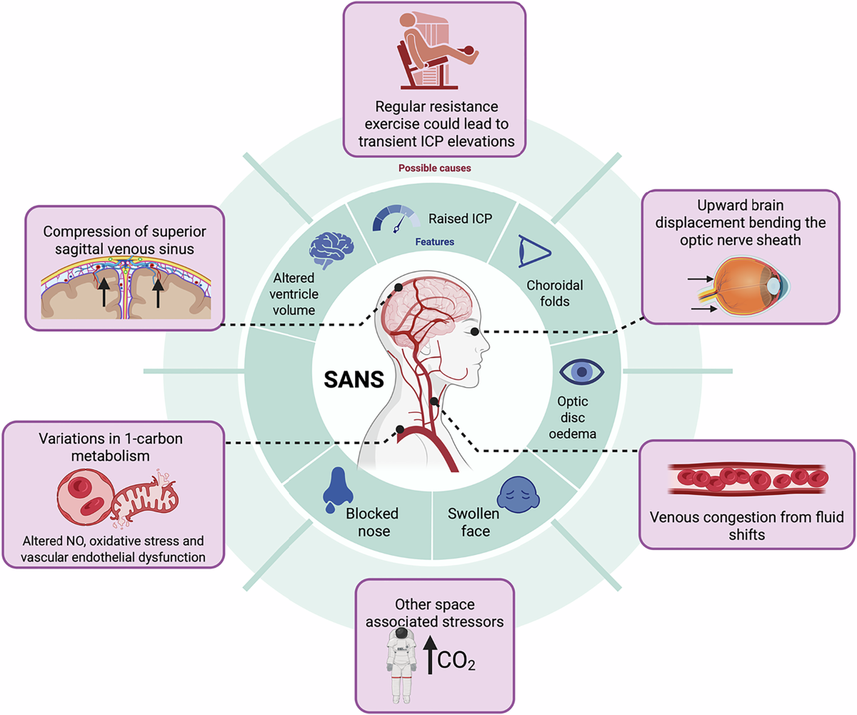 Spaceflight-associated neuro-ocular syndrome (SANS): expert consensus on diagnosis and management