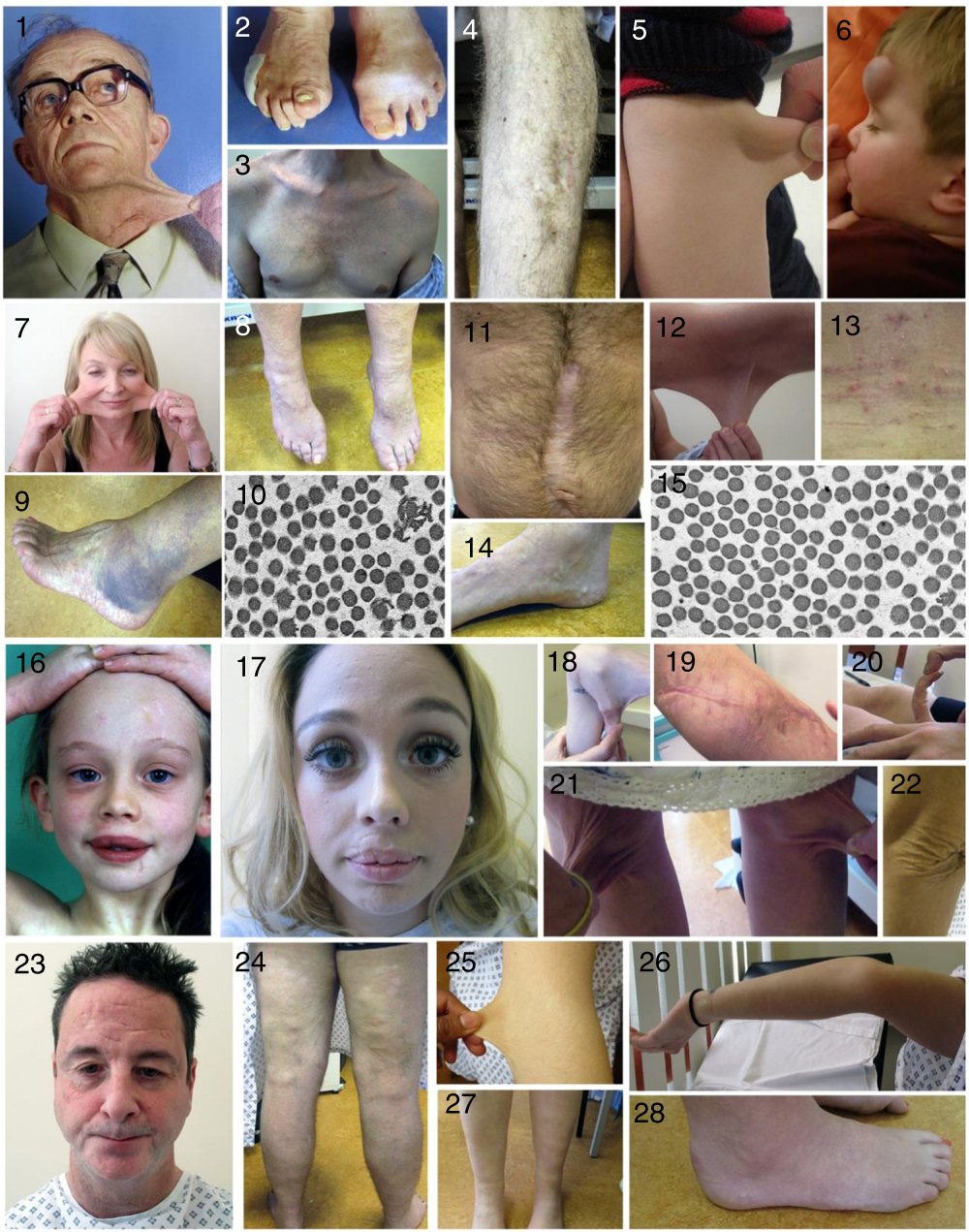glutathione ehlers danlos Ehlers-Danlos Syndrome, Hypermobility, and Mast Cell Activation Syndrome: The Connection Expanding the clinical and mutational
