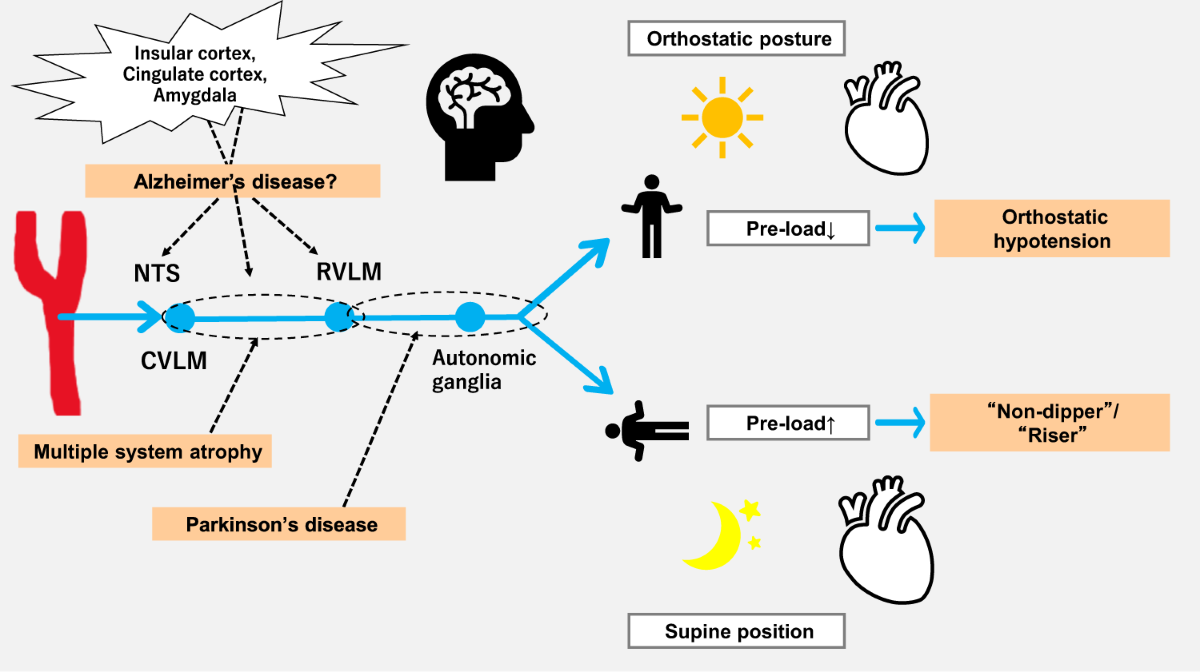 orthostatic hypotension tirzepatide Orthostatic hypotension with nondipping: phenotype of neurodegenerative  disease