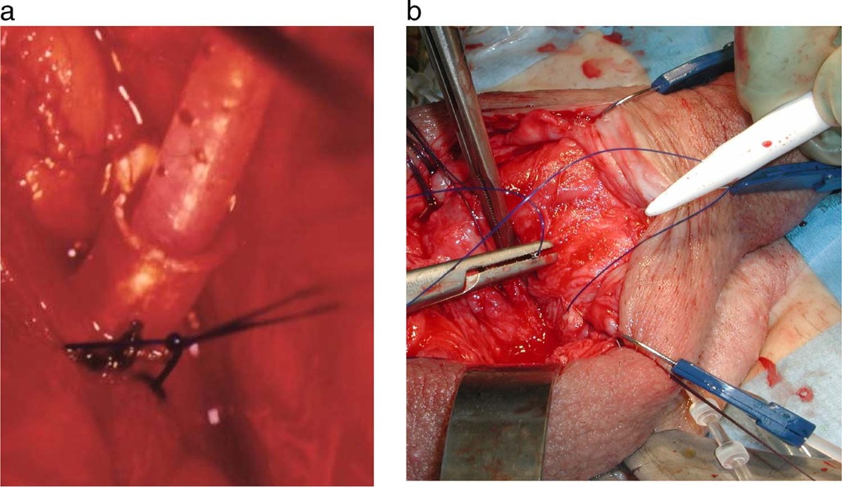 Inflatable penile prosthesis cylinders out of place during implantation |  International Journal of Impotence Research