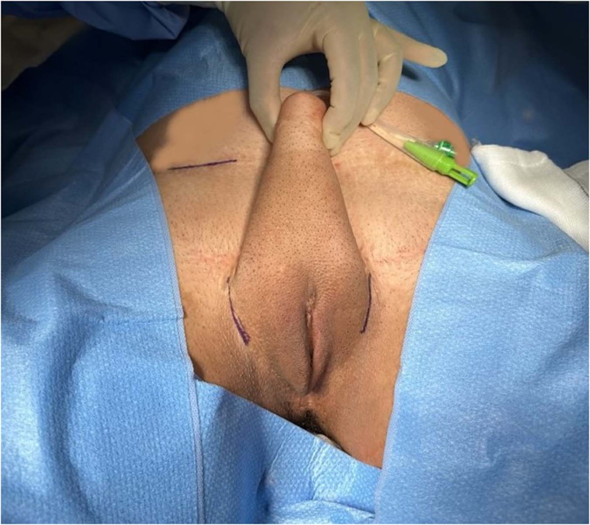 Erectile device insertion following phalloplasty in transgender and  non-binary individuals assigned female at birth: a narrative review |  International Journal of Impotence Research