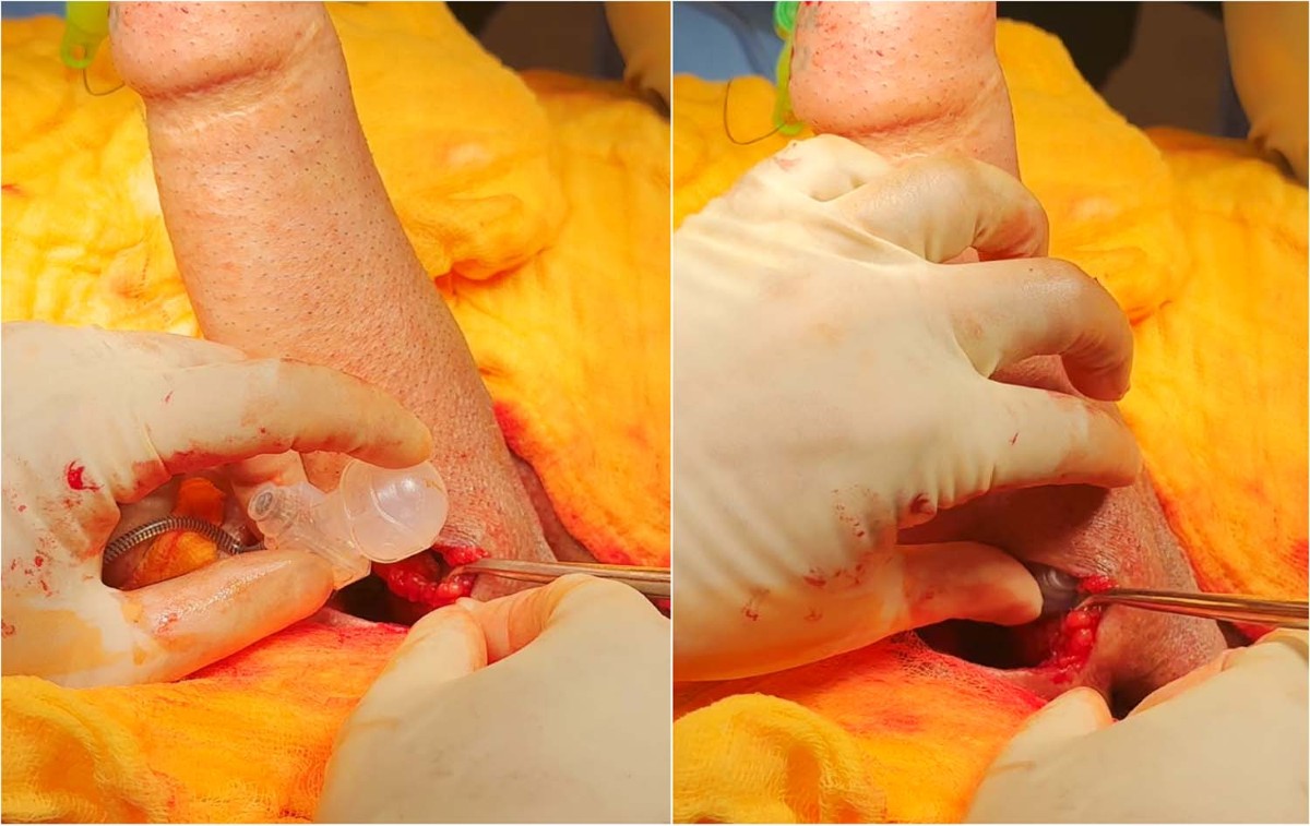 trans gender operasion Erectile device insertion following phalloplasty in transgender and  non-binary individuals assigned female at birth: a narrative review |  International Journal of Impotence Research