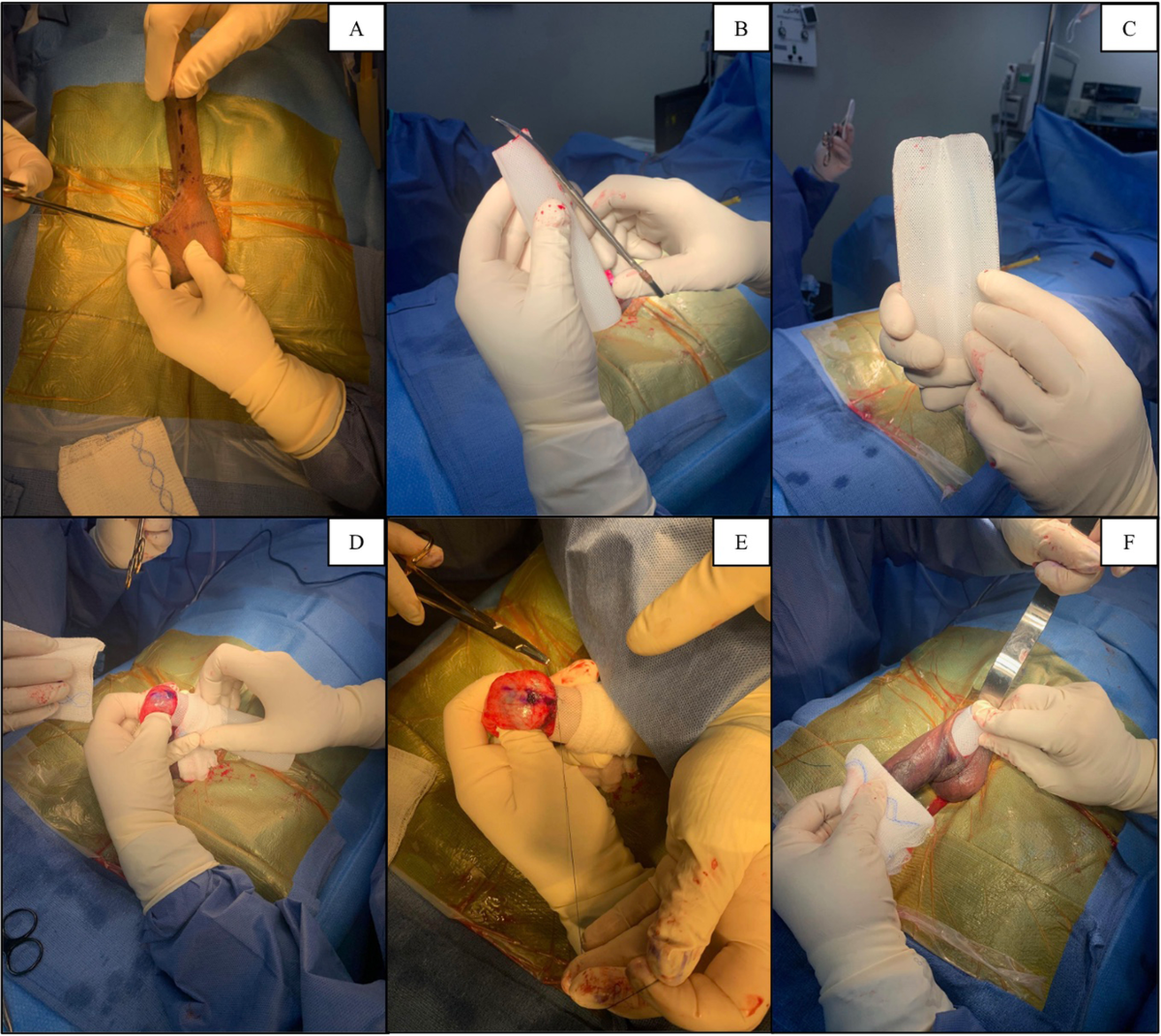 Himplant® subcutaneous penile implant improves penile appearance 