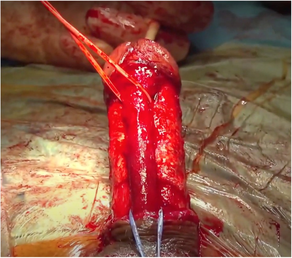 First worldwide correction of ventral Peyronie's disease utilizing rigicon  inflatable penile prosthesis combined with plaque incision & grafting with  collagen fleece (PICS-technique) for residual curvature | International  Journal of Impotence Research