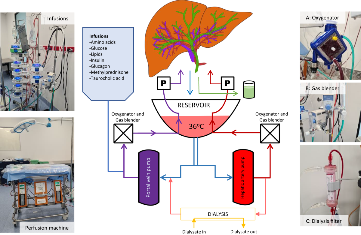 Long-term ex situ normothermic perfusion of human split livers for more  than 1 week | Nature Communications