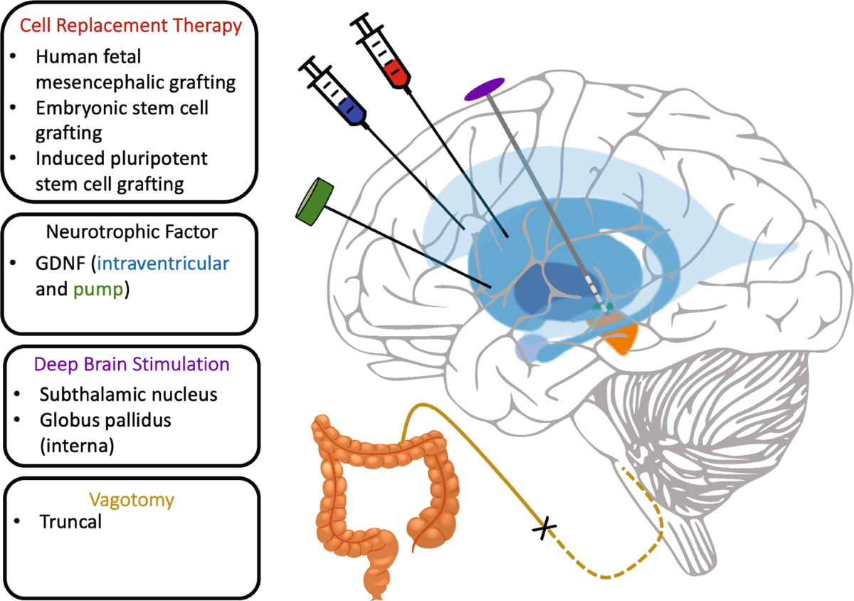 Comparative efficacy of surgical approaches to disease modification in Parkinson disease