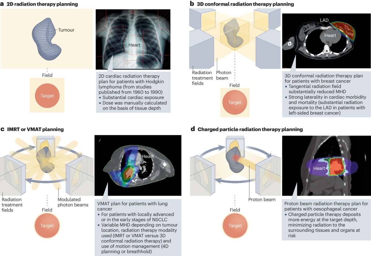 Consequences of ionizing radiation exposure to the cardiovascular system |  Nature Reviews Cardiology