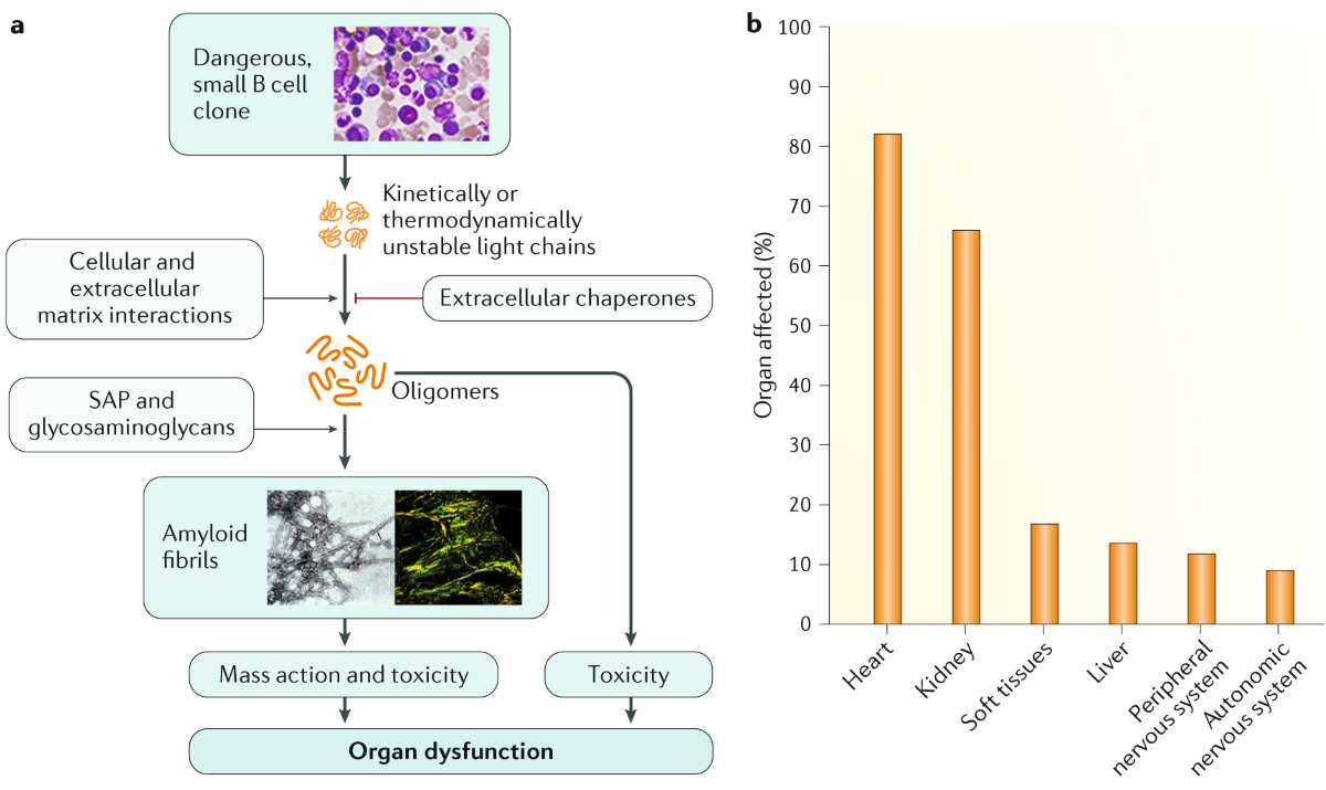 Systemic immunoglobulin light chain amyloidosis | Nature Reviews Disease  Primers