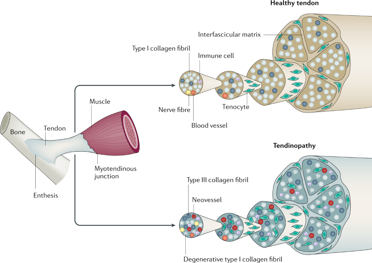 glutathione tendonitis Tendinopathy