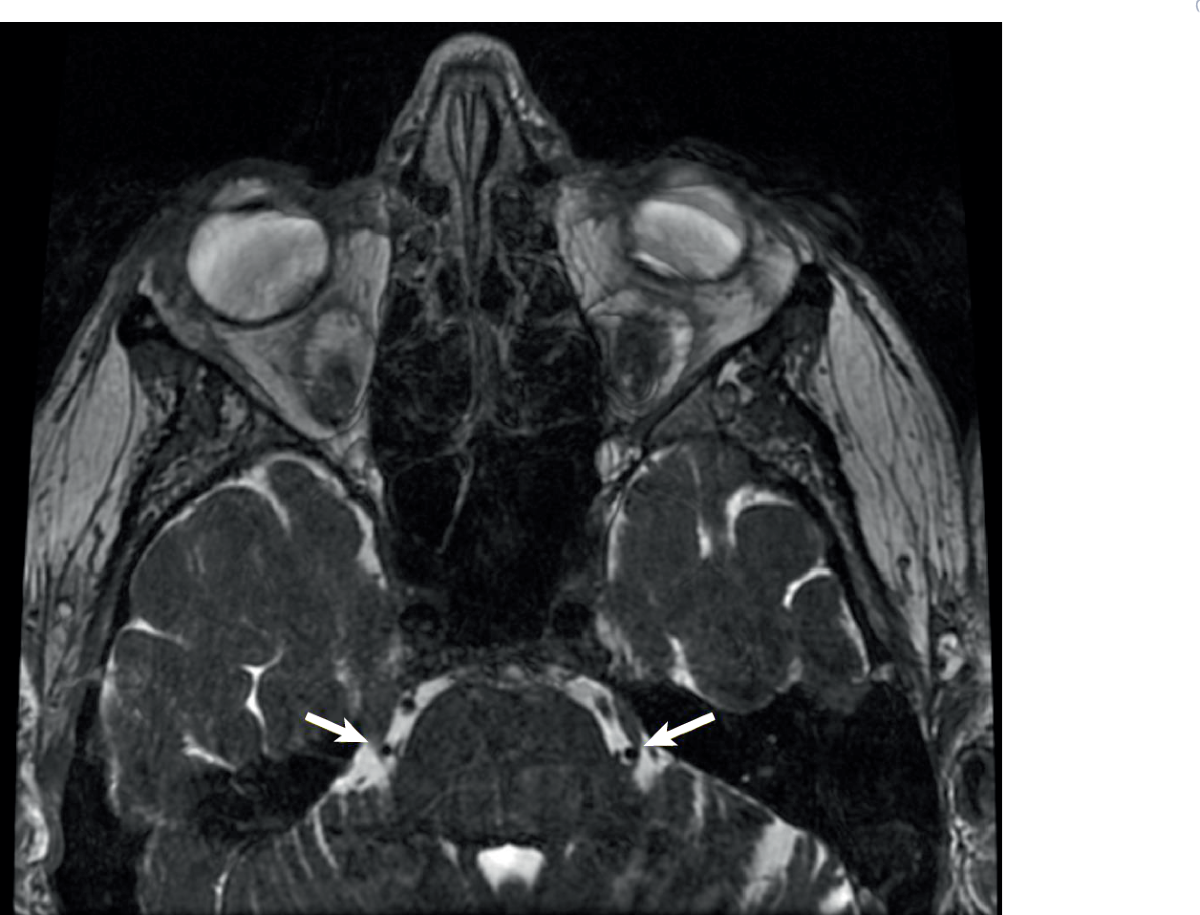 Pictorial Review of Cranial Nerve Denervation in the Head and Neck |  RadioGraphics, image size:1200x915