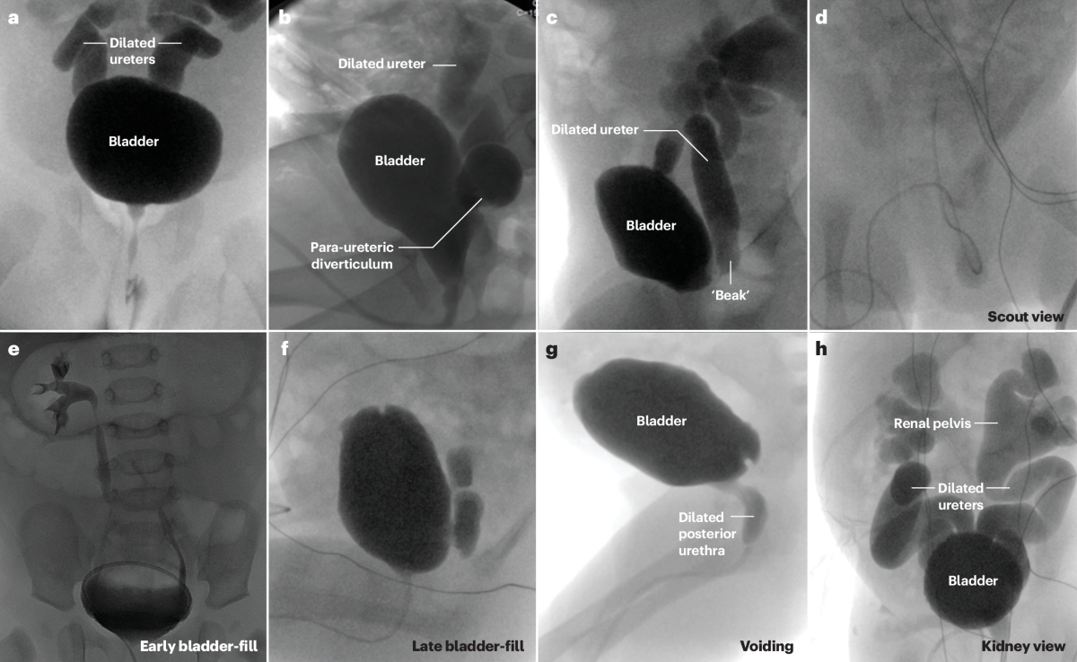 Primary vesicoureteral reflux | Nature Reviews Disease Primers