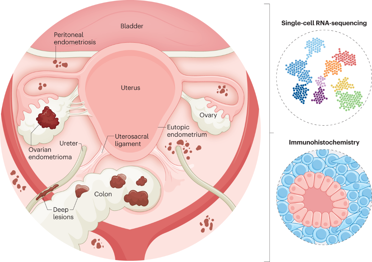 semaglutide and endometriosis A novel resource to study endometriosis at the single-cell level