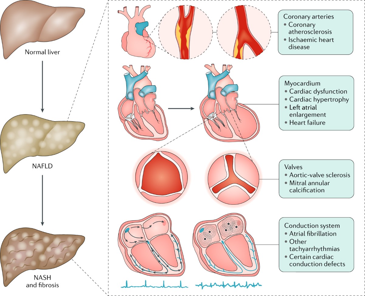 Risk of cardiomyopathy and cardiac arrhythmias in patients with  nonalcoholic fatty liver disease | Nature Reviews Gastroenterology &  Hepatology