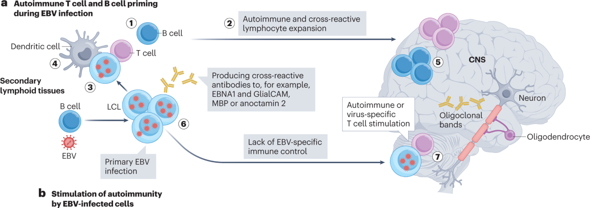 Epstein-Barr Virus Exposed: New Research Links Common Infection to Autoimmune Diseases Like Lupus and MS