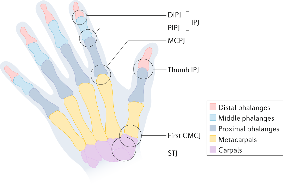 Hand osteoarthritis: clinical phenotypes, molecular mechanisms and disease  management | Nature Reviews Rheumatology