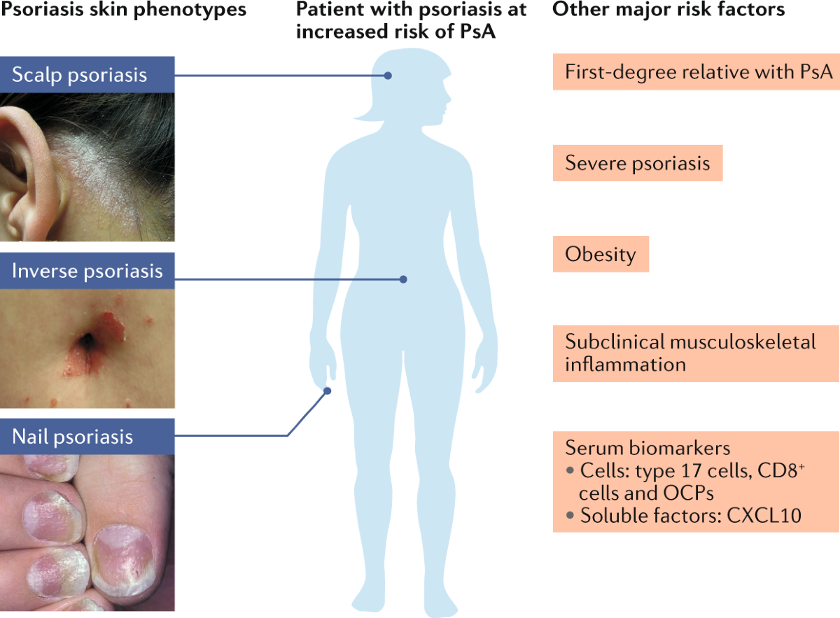 Preventing psoriatic arthritis: focusing on patients with psoriasis at  increased risk of transition | Nature Reviews Rheumatology