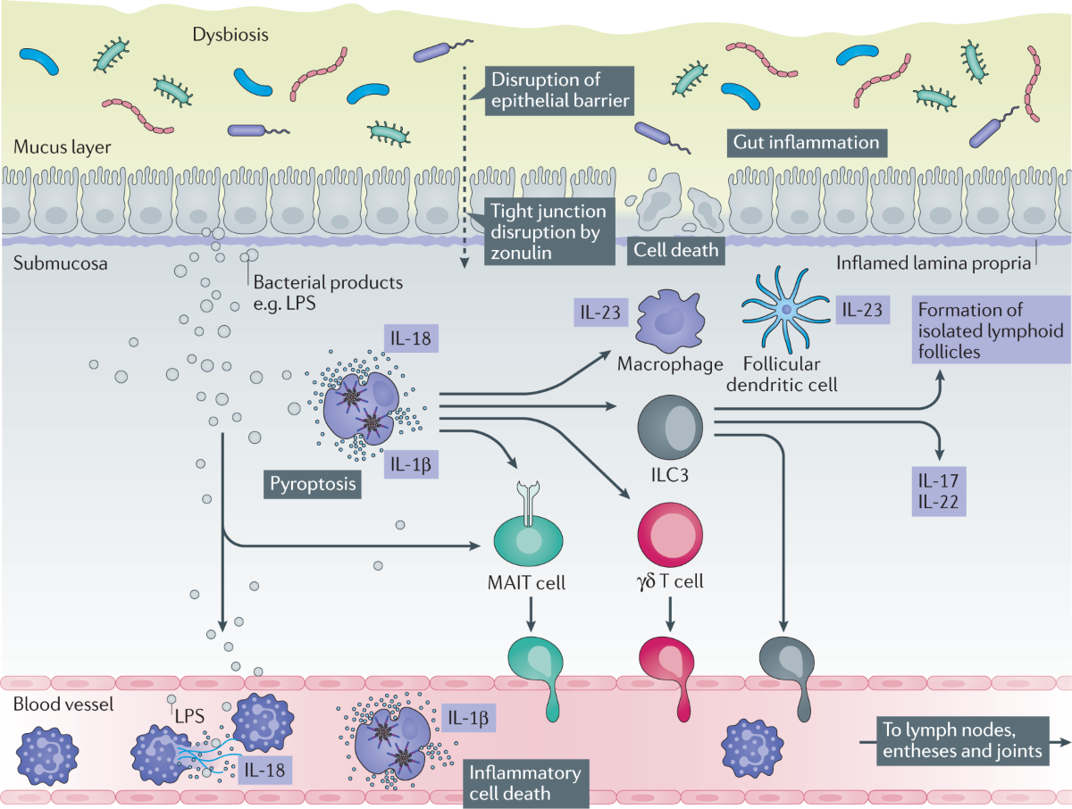 glutathione and ankylosing spondylitis spondylitis: an autoimmune or autoinflammatory disease? Fragrance:Vanilla