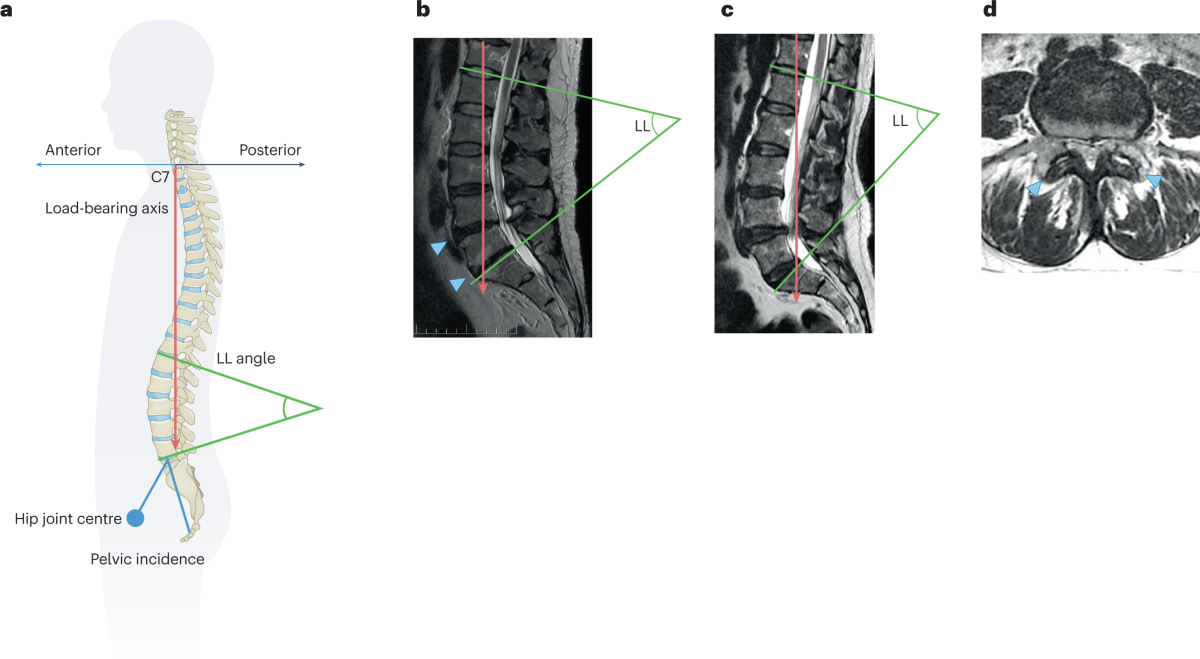 bpc-157 intervertebral disc degeneration study Intervertebral disc degeneration and osteoarthritis: a common molecular  disease spectrum